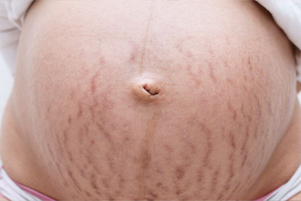 5 Bahan Alami untuk Menghilangkan Stretch Mark