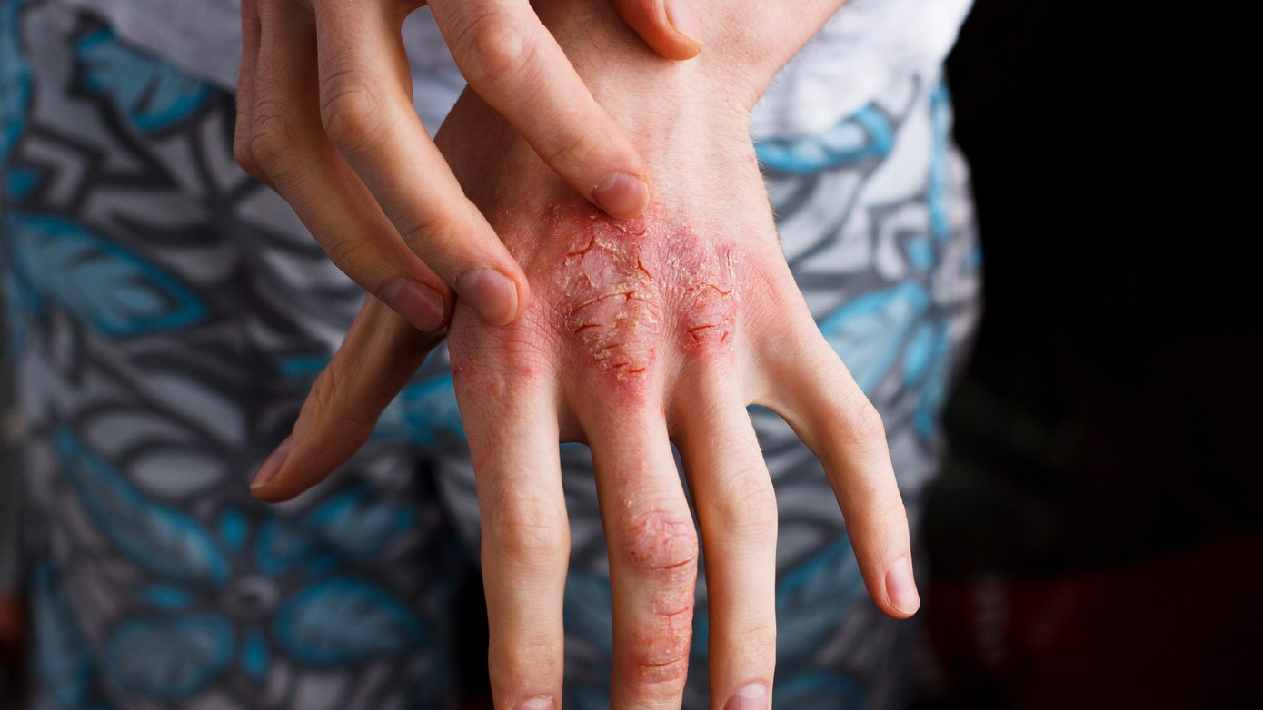 Dermatitis Atopi