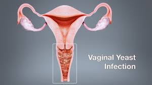 Candidiasis Vaginalis