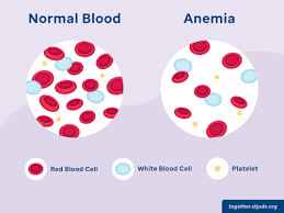 Anemia