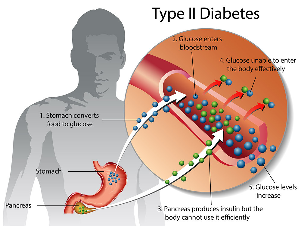 Diabetes Melitus Tipe 2