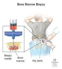 Pemeriksaan Sumsum Tulang