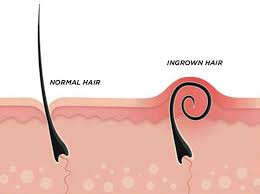 Komplikasi Ingrown Hair, Rambut Tumbuh ke Dalam