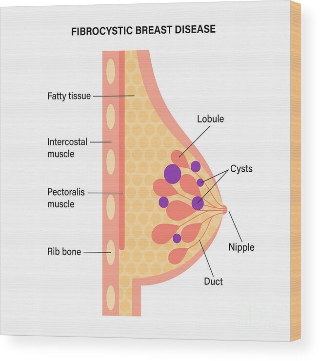 Fibrokistik Payudara