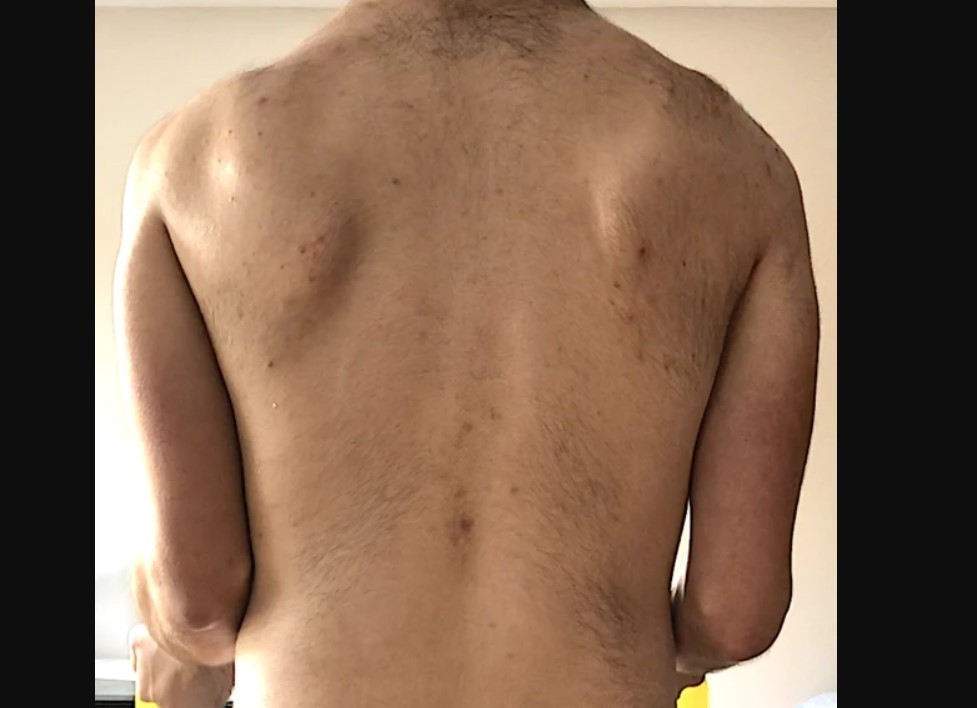 Facioscapulohumeral Muscular Dystrophy (FSHD)