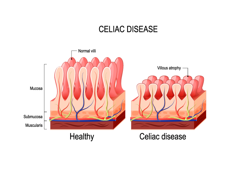 Penyakit Celiac