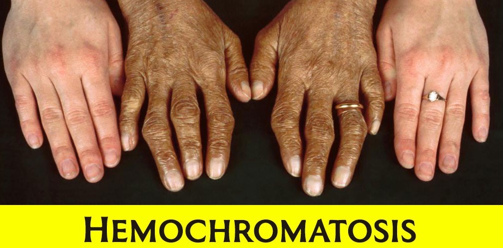 Hemokromatosis
