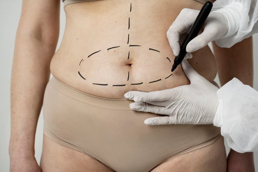 Persyaratan untuk Melakukan Liposuction