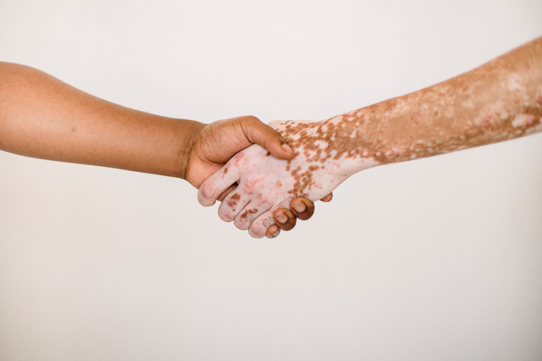 Mengenal Vitiligo, Kelainan Kulit Akibat Gangguan Sistem Kekebalan Tubuh